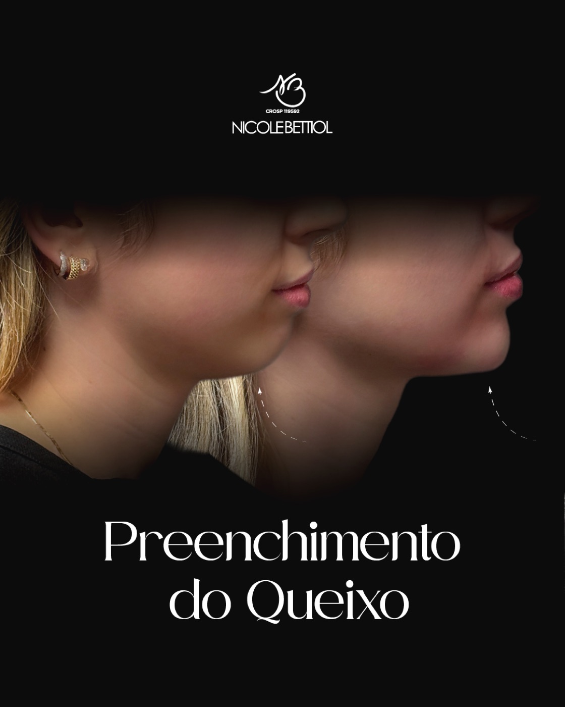 Caso clínico: Preenchimento de queixo
